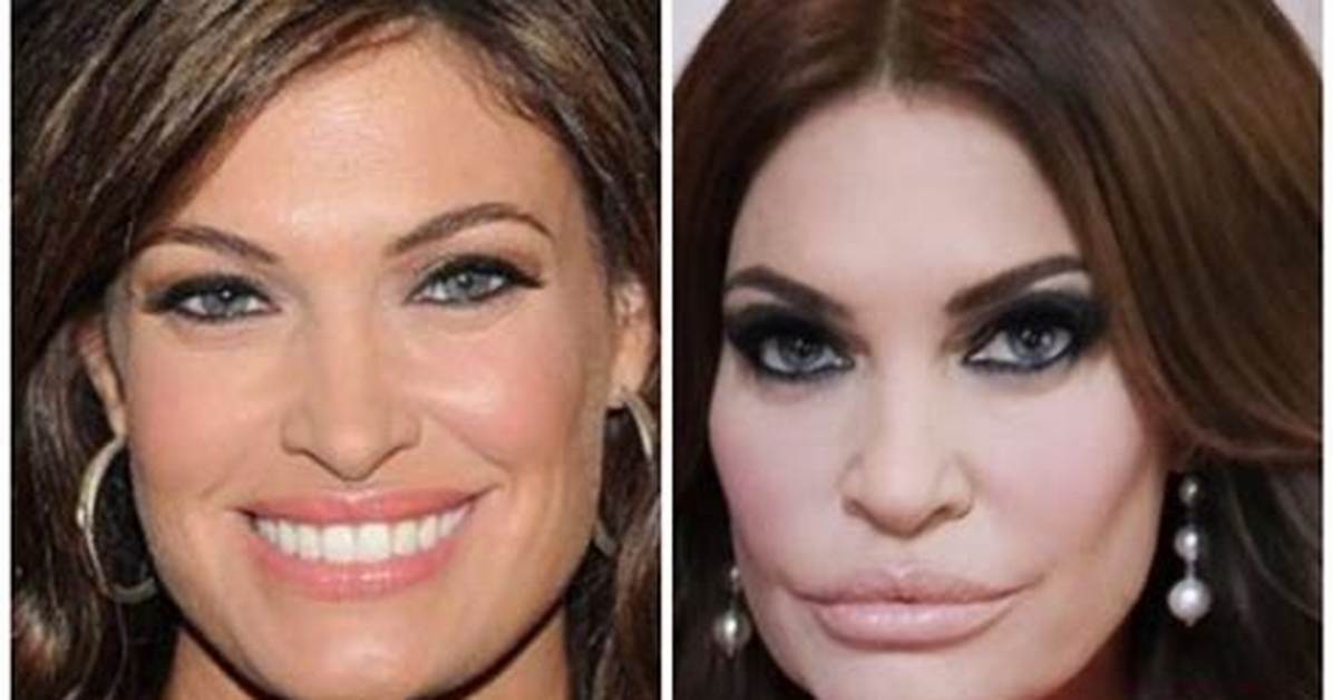 Kimberly Guilfoyle Before Cosmetic Procedures: Dramatic Transformation Revealed